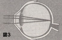 近視手術の図解3